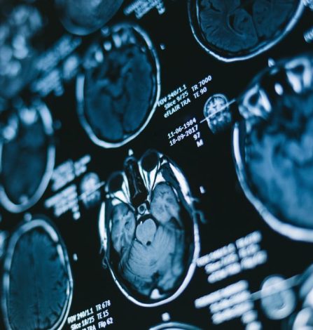 Magnetic resonance of the brain